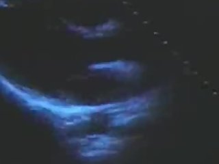 Japanese TV Echocardiogram with Heartbeat Sound (Old / LoRes)